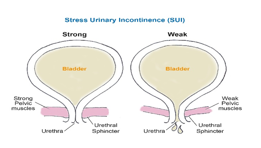 Strong vs. weak pelvic muscles diagram