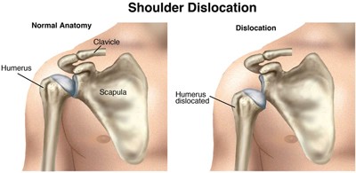 Diagram showing shoulder dislocation