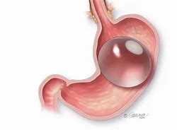 A close-up of a stomach with a Intragastric Balloon inside of it.
