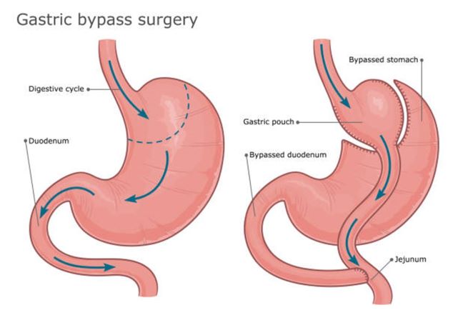 Gastric bypass surgery Gastric bypass surgery before and after. Vector illustration. bariatric surgery stock illustrations