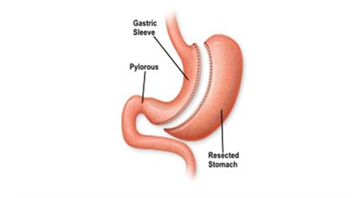 A diagram of a gastrectomy